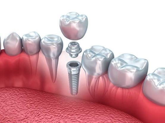 Próteses e implantes dentários: Qual é a diferença?