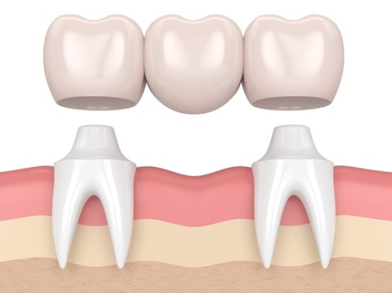 Próteses e implantes dentários: Qual é a diferença?